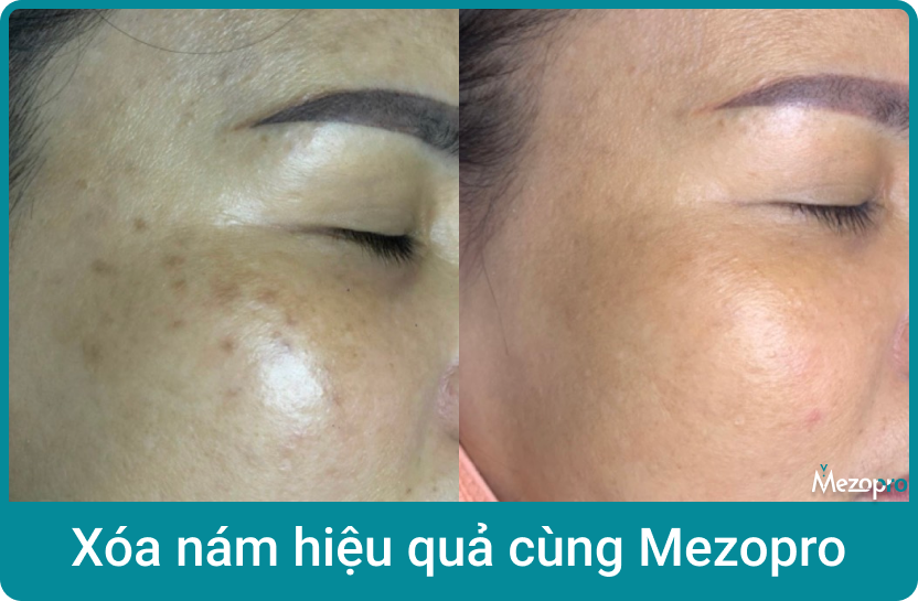 nam-2
